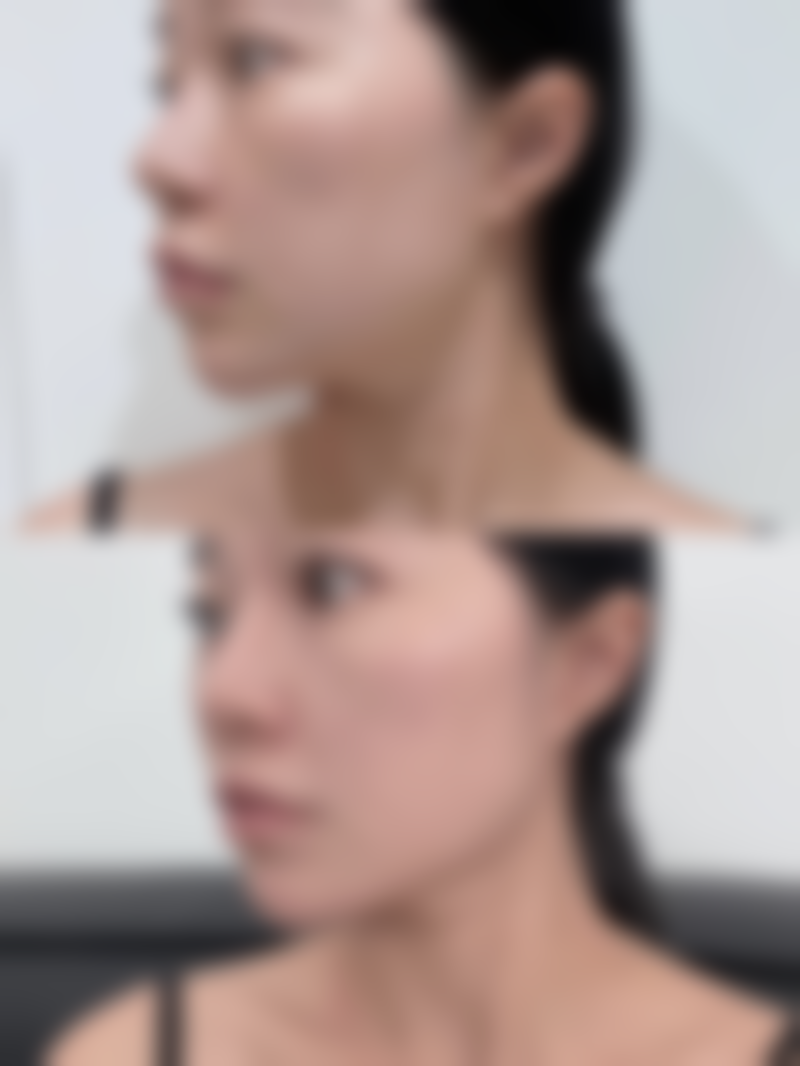 隆鼻子能保持一辈子吗——硅胶隆鼻的15 - 20年之约