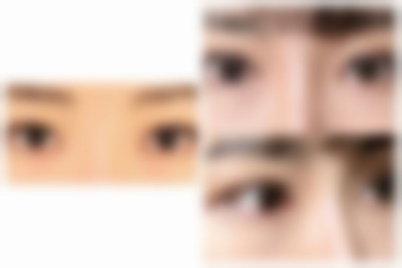 光子嫩肤治疗疤痕真实实例分享：见证奇迹时刻