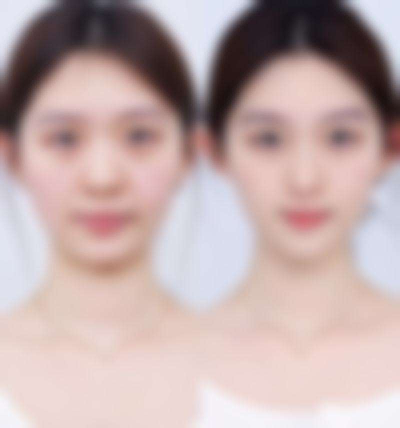 刀疤疤痕如何修复——预期成效和价格参考