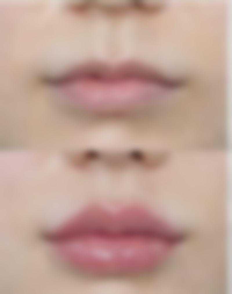 线提升隆鼻吸收完的影响因素之延长成效与修复选择