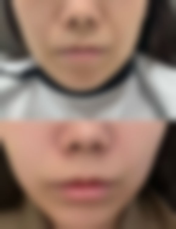 打瘦脸针脸肿：正常反应、危险信号与人为因素分析