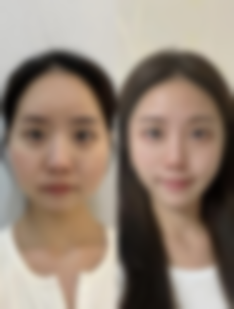 黑眼圈眼袋如何改善之运动助力：活力对抗熊猫眼