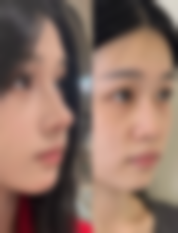 打瘦脸针脸肿：肿胀期间的生存法则