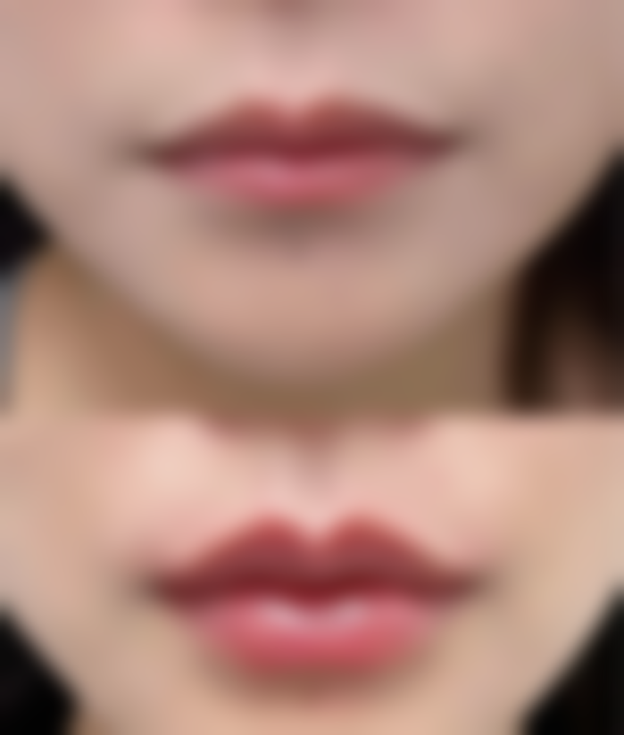 打瘦脸针脸肿：医学认证的消肿加速器