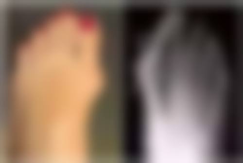 盐水假体隆胸大力抓有何风险？安心相对仍需小心谨慎