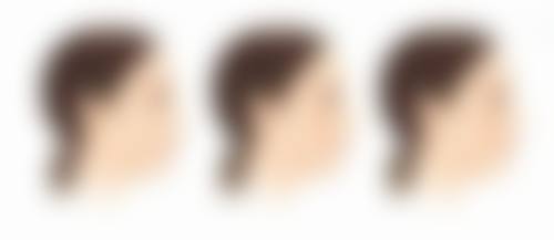 隆鼻的寿命有多长？硅胶10年膨体20年，肋软骨竟能维持这么久！