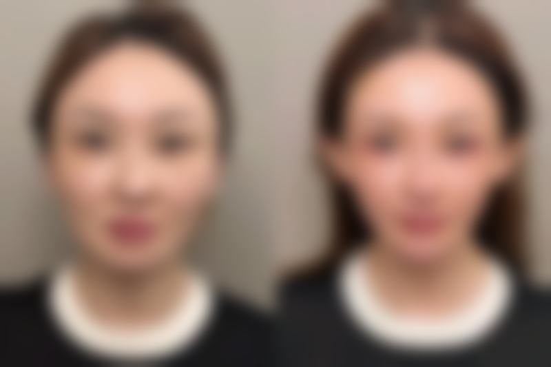 假体隆胸后早期用力抓会怎样？修复关键期需谨慎对待