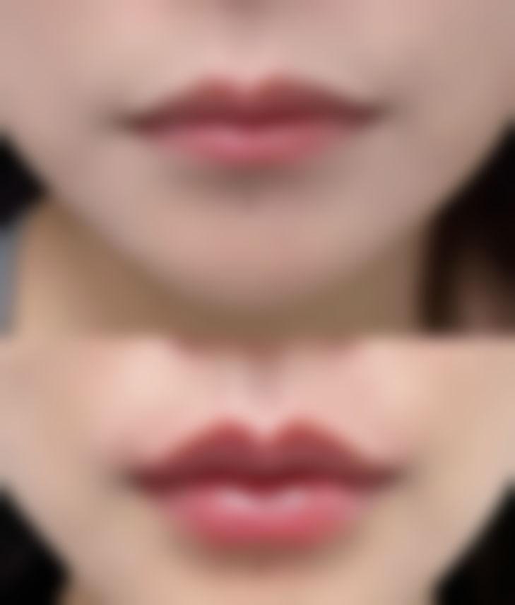 多少岁可以抽脂吗？成年人抽脂的条件与适宜年龄