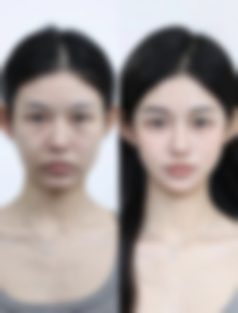 怎样去掉儿童烧伤的疤痕——小天使的特殊需求