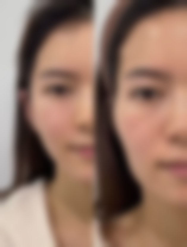 合资隆胸假体之蜜桃假体 — 中美合资性价比的出色之选