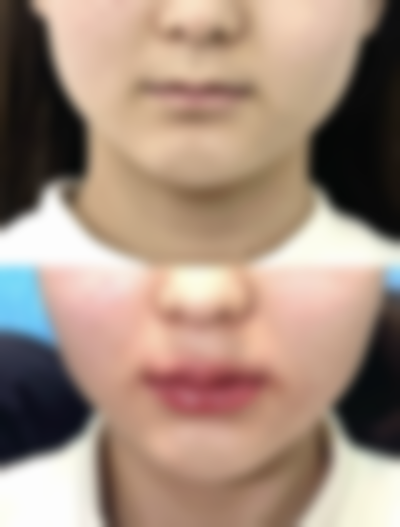 怎样去掉轻度与重度烧伤的疤痕——对症下药