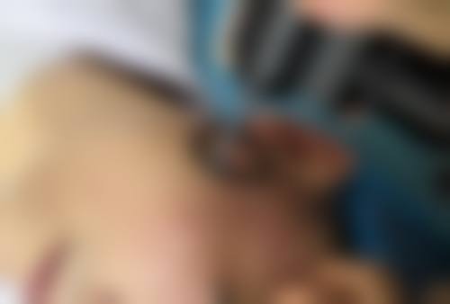 脸部咬伤疤痕怎么去除：不同程度疤痕的应对策略