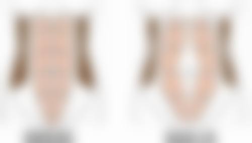 抽脂部位差异:局部抽脂 vs 全身抽脂风险等级