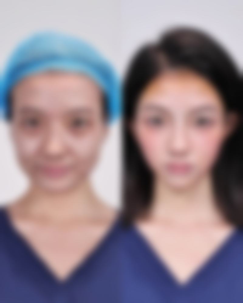 抽脂量把控:安心与危险的抽脂量临界点