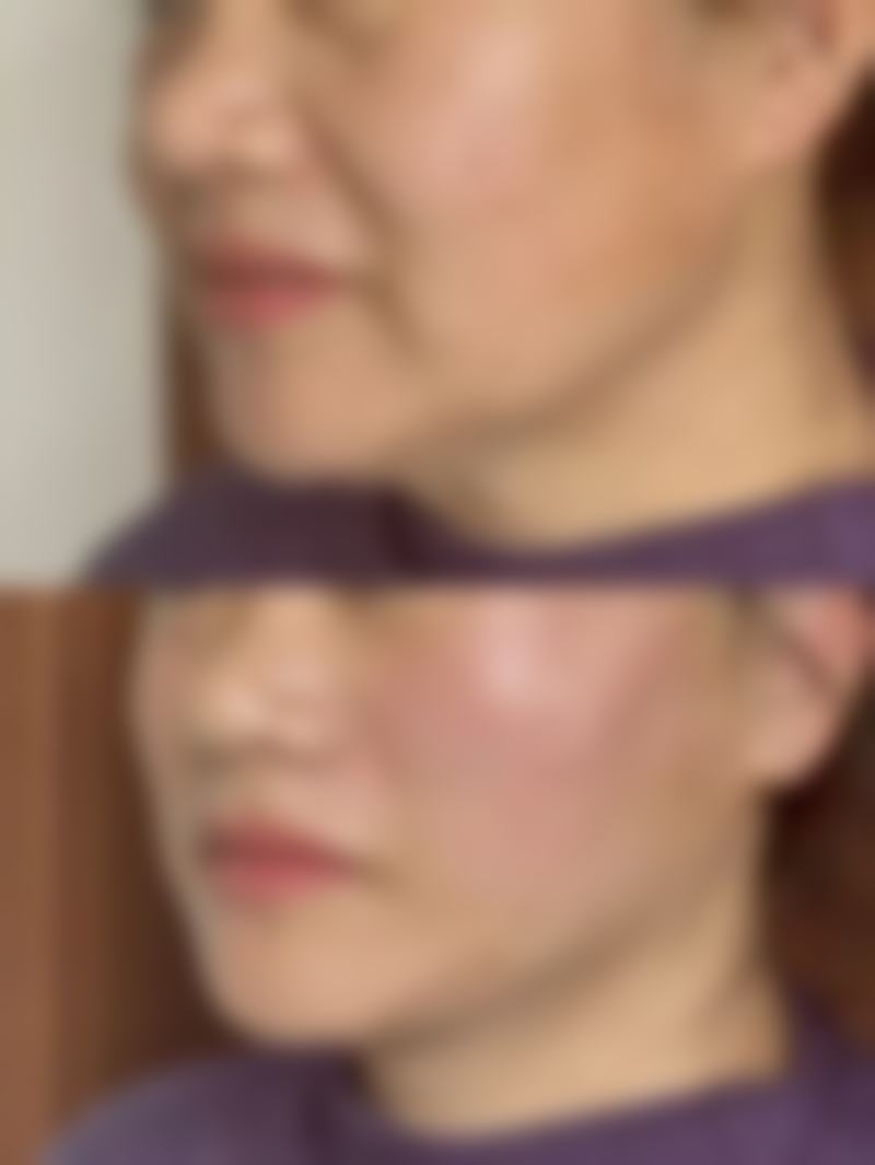 猫咬伤疤痕怎么去除：特殊情况特殊对待