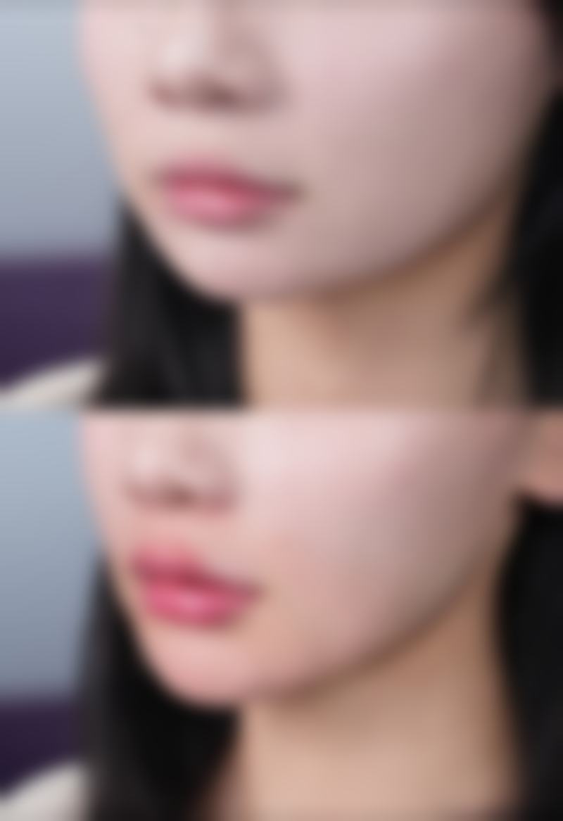 怎样去除烧伤增生性疤痕好——长治二院的多学科协作方案