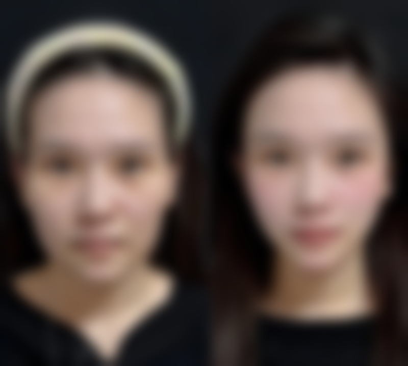 疤痕性青春痘如何治疗：饮食秘诀吃出光滑美肌