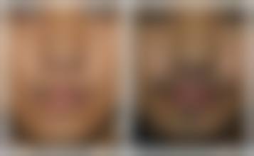 韩国第一按钮整形外科抖音团购活动有哪些，价格表