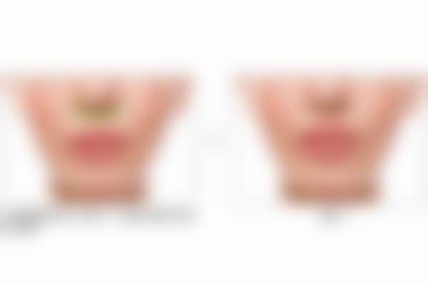 【鼻部综合肋软骨隆鼻特别优惠促销，5折仅需49800元+8900】北京蕾士悦容项目简介