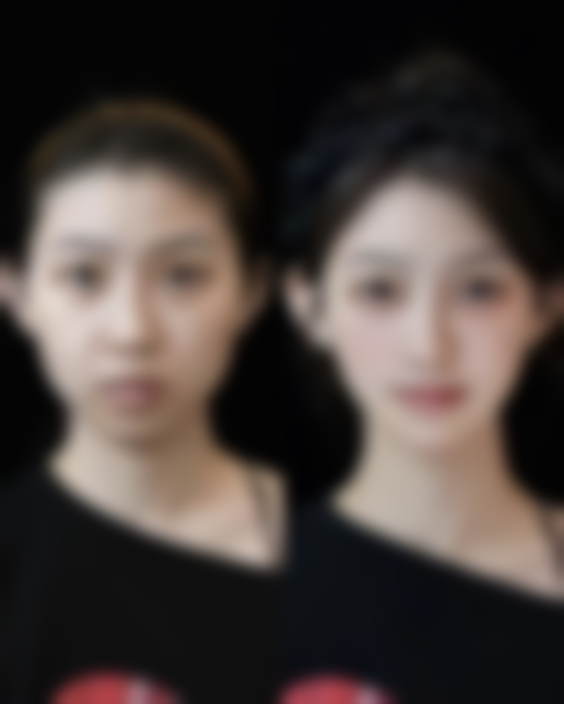 去除疤痕疙瘩的手术治疗：完全切除的终极抉择