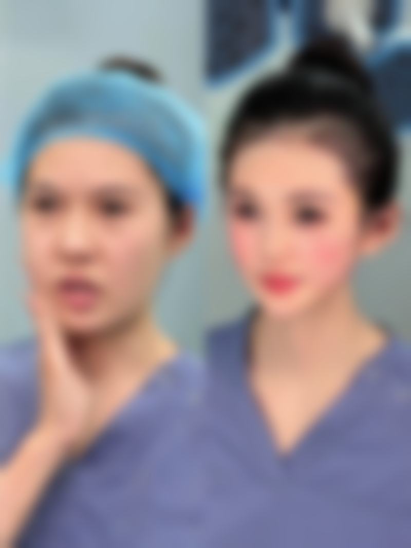 隆鼻整形后假体透光怎么办？3大修复方案+避坑指南来了