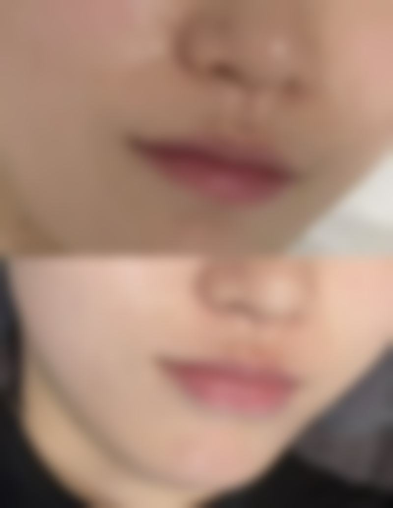 隆鼻整形后假体透光怎么办：修复手术怎么选