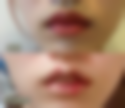 广深成杭四大城市埋线双眼皮成效对比