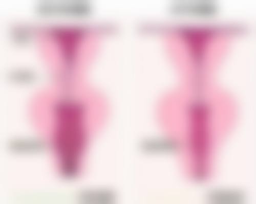 进口与国产假体对生育影响的差异剖析