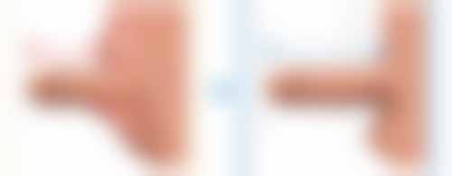 双眼皮怎么去除肉条感——修复前必知的6大注意事项