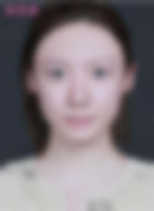 【单部位面部吸脂 面部吸脂+15000】北京米兰柏羽丽都高海燕医生精细分层吸脂打造小V脸成效超棒之顾客实例