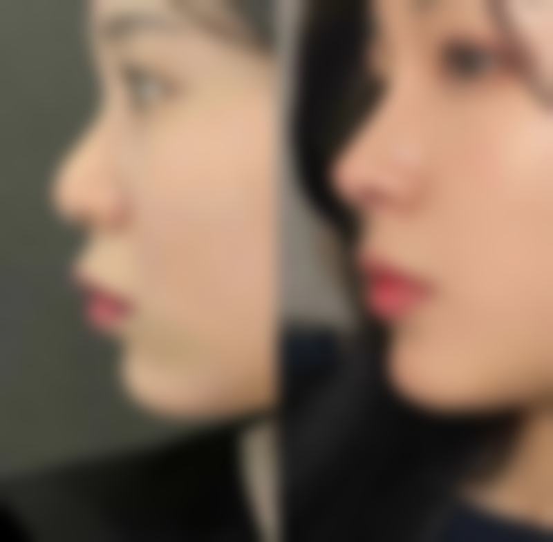 怎么可以臀部抽脂之国有医院的正规性优势