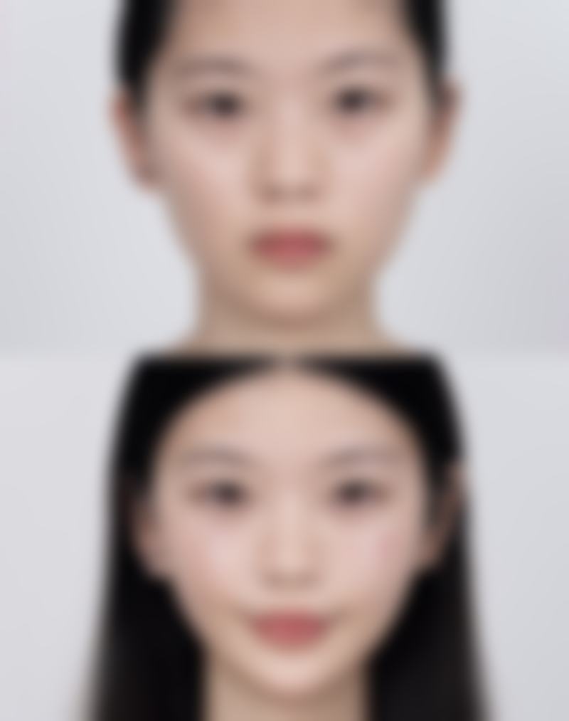 双眼皮怎么去除肉条感，3-6个月修复黄金期+专业医院推荐指南