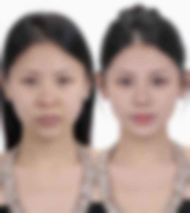 怎么可以臀部抽脂之快速修复和塑形技巧