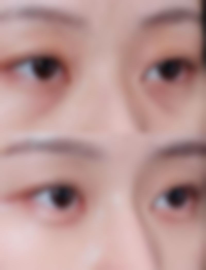 血压高能做眼袋手术吗之术前注意事项全知道