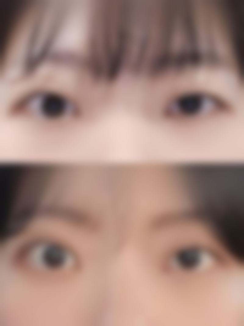 双眼皮埋线成效究竟如何：骨干医生具有影响力解答自然度、持久性与修复期