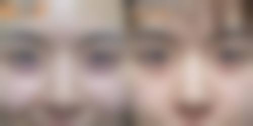 疤痕体质的人纹眉对身体长期与心理的影响