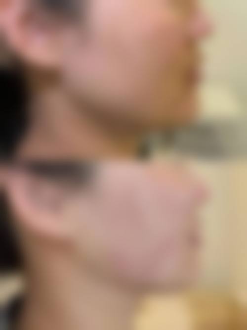 杭州悦可医疗美容诊所熊员平实例成效——杭州瑞丽医疗美容医院