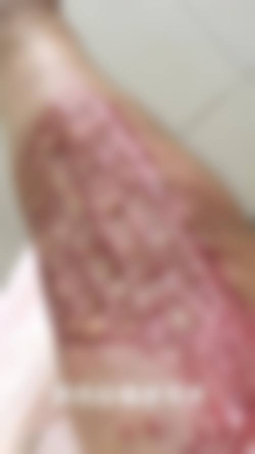 杭州悦可医疗美容诊所熊员平实例成效——杭州维多利亚医疗美容医院