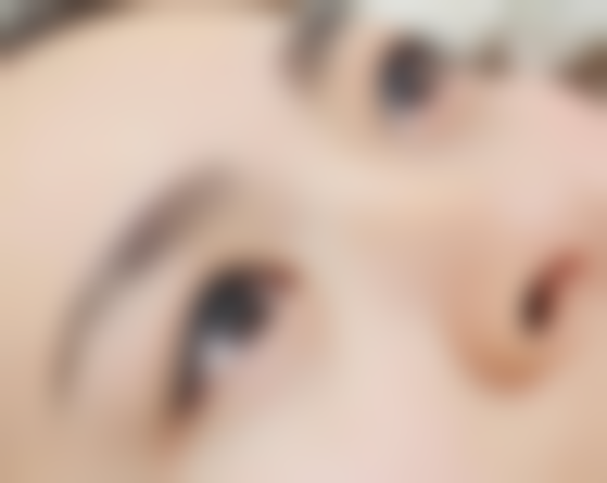 凸出疤痕怎样变平？激光点阵+压力衣双管齐下，告别蜈蚣疤！