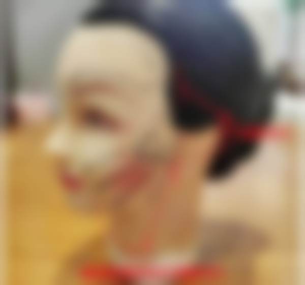 63岁拉皮实例：手术过程与修复的贴心分享