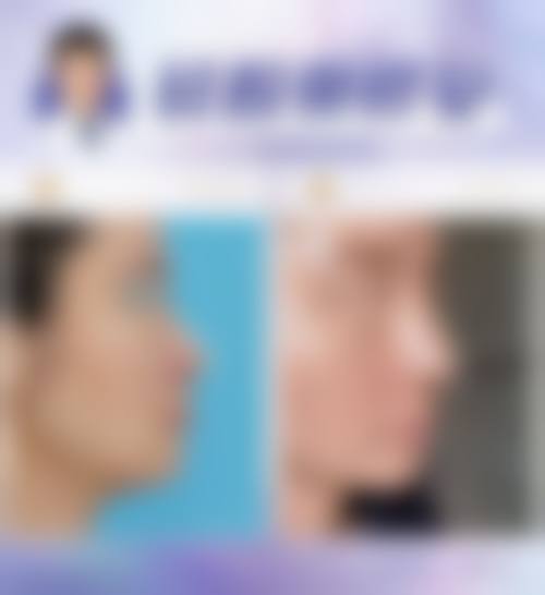 广州高尚医学美容中 心程飞手术风格——成都东篱整形医院