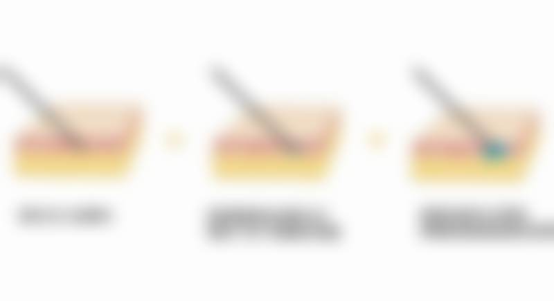 【乳房下垂矫正+50000】广州高尚余文林医生手术预约方式