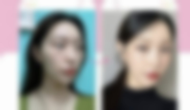 艾条去除眼袋，短期与长期成效究竟如何