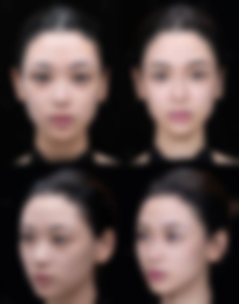 不治疗疤痕疙瘩的代价:放任不管危害多