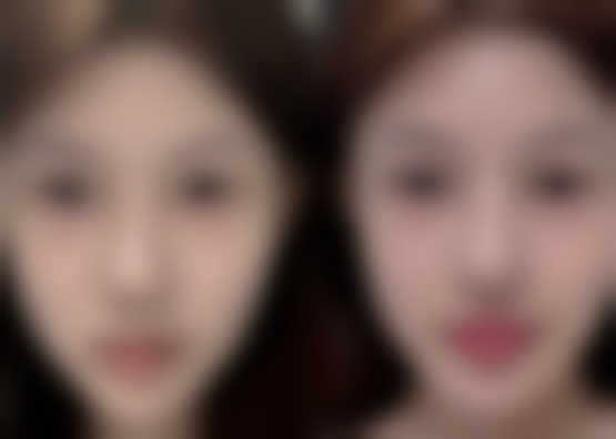 割双眼皮多久可以运动