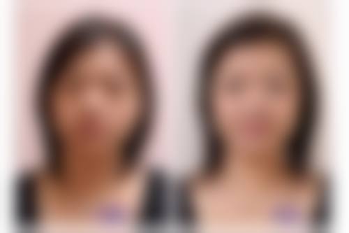 中医针灸医院：从内而外调理黑眼圈眼袋