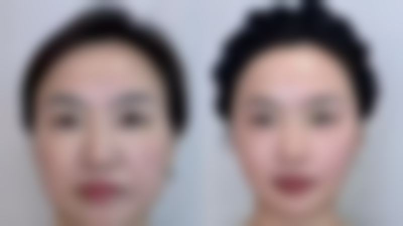 爱贝芙隆鼻成效不恒久之注射量不足问题