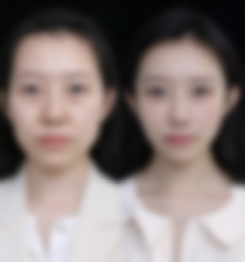 按摩后眼袋多久可以消肿