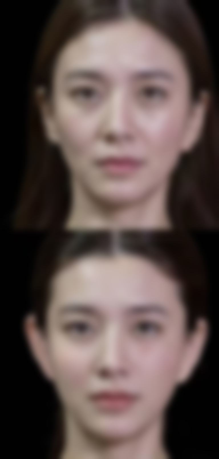 早上起来眼睛浮肿眼袋大如何快速消肿