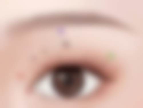 成都眼部整形修复套餐（双眼皮手术失败修复）16800性价比分析